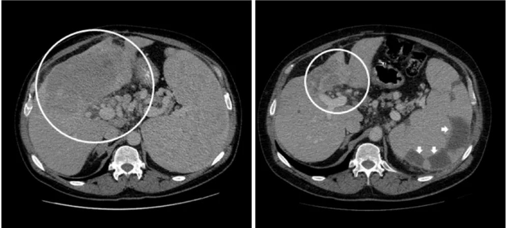Figure 2: Prolonged partial response for 12.1 months noted in the primary hepatic lesion of a patient with advanced cholangiocarcinoma treated with hepatic arterial infusion of a cytotoxic agent along with intravenous anti-angiogenic agent