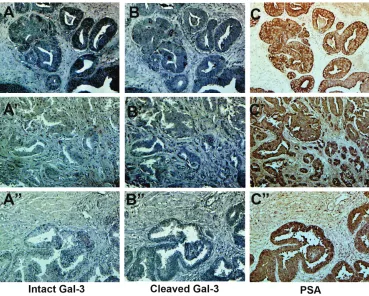 Figure 4: cleavage of galectin-3 in Pca and normal tissues. A PCa tissue array was stained for intact and cleaved galectin-3 using monoclonal and polyclonal anti-galectin-3 antibodies, respectively