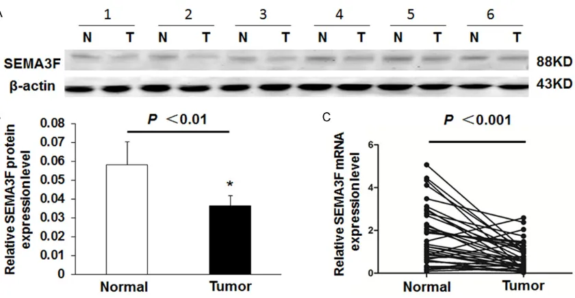 Figure 1. SEMA3F expression in CRC tissues and adjacent non-tumor tissues. A: Representative result of SEMA3F protein expression in six matched samples of CRC tissues (T) and adjacent non-tumors tissues (N)
