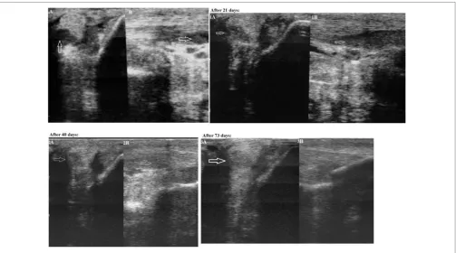 FIGURe 1 | First case—transverse (Panel A) and longitudinal (Panel B) projections of the lateral crus of the suspensory ligament in zone 3C on an ultrasound  image (an arrow indicates the anechoic and hypoechoic zone of the injury)