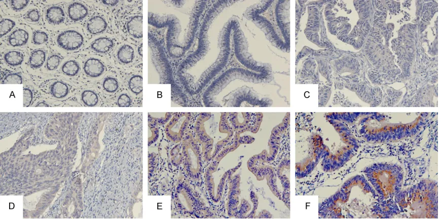 Figure 1. Representative cases of ITGB1 expression in normal mucosa, adenomas and different CRC tumor stages