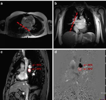 Fig. 3 Normal transmitral inflow pattern. E, initial rapid early flow;A, late or atrial flow