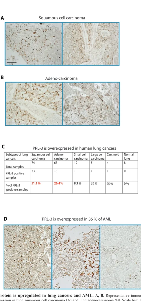 Figure 6: PRL-3 protein is upregulated in lung cancers and AML.  A, B. Representative immunohistochemistry (IHC)  staining of PRL-3 expression in lung squamous cell carcinoma (A) and lung adenocarcinoma (B)