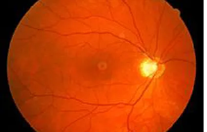 Figure 1 An fundus image-an array or a matrix of pixels arranged in columns and rows 