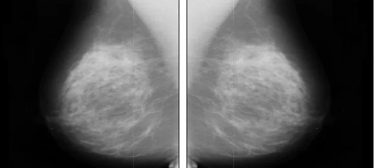 Fig. 2.  Right- Sided Mammogram and Flipped Mammogram (Left Sided) 