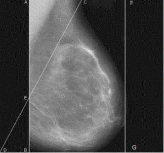 Fig. 3.  Original and Processed Mammogram 