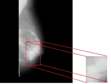 Fig 5.  Background and Pectoral Muscle Eliminated Mammogram   