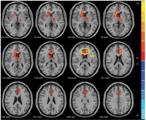 Figure 3 comparison of the effect of acupuncture in contra-group and ipsi-group. in this study, the acupuncture effect was post minus preacupuncture in contra-group or (acc, Mni coordinates: Abbreviation:ipsi-group