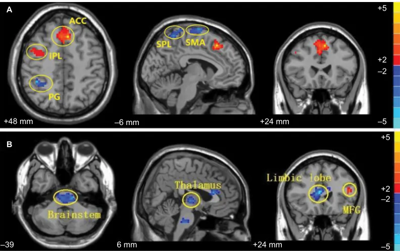 Figure 4 comparison of the post and preacupuncture scans in contra-group ((Abbreviations: A) and ipsi-group (B)
