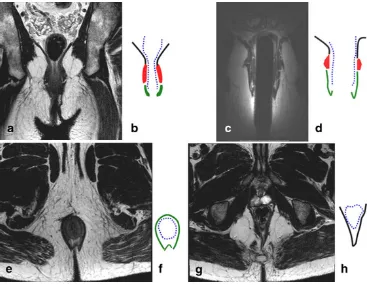 Fig. 1 Coronal T2-weightedimage of the pelvic floorobtained by surface coil (a), andschematic representation (b).Coronal T2-weighted imageobtain by endoanal coil (c) andits schematic representation (d).Axial T2-weigted image at thelevel of sphincters (e) a