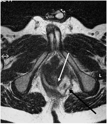 Fig. 6 Sagittal T2-weighted image (a) and T2-weighted coronalimage with fat-saturation (b) show an abscess (thick white arrows on aand b) at the level of anorectal junction
