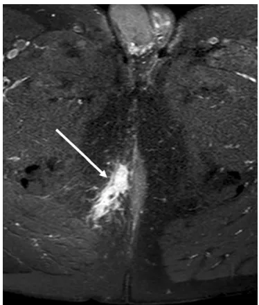 Fig. 9 Sagittal (a) and coronal(b) T2-weighted images of apatient treated with seton atfollow-up