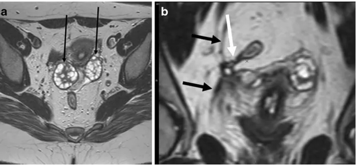 Fig. 15 Patient with healedwith surface coil enabled evendemonstration of pathology inthe pelvis