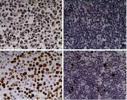 Figure 1. Immunohistochemical staining of PGI-DLBCL tissues. A. Positive staining of CD10