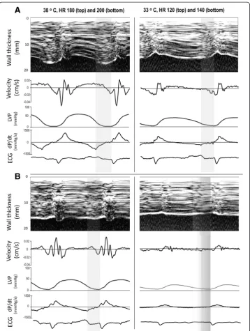 Figure 4 Recordings from the ultimate tolerable (A) and the following not tolerable heart rate (B)during normo (left) and hypothermia (right)