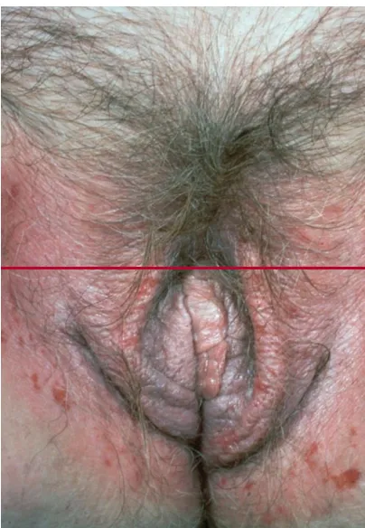 Figure 2: Contact dermatitis affecting the female genitalia. Note poorly defined erythema of the genitocrural skin, erosions due to excoriation in the inflamed skin and white thickening (lichenification) of the labia majora due to scratching