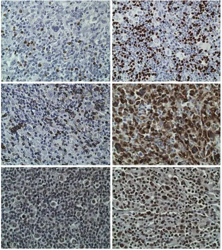 Figure 2. HLIL expression of (A) FoxP3, labeled as 9% staining in case 7, (B) FoxP3, labeled as 40% in case 11, (C) TIA-1, 15% in Case 4, (D) TIA-1, 87% Case 10, (E) Sirt1, 50% in Case 6, (F) Sirt1, 88% Sirt1 in Case 10