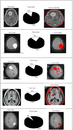 Fig. 4 Tumor region is extracted from the original malignant brain MR image with its area 
