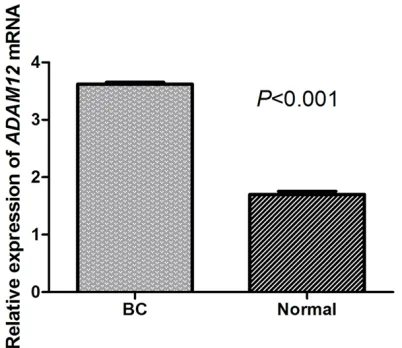 Figure 1. The expression level of ADAM12 in tumor tissues and adjacent normal tissues of ER-positive breast cancer