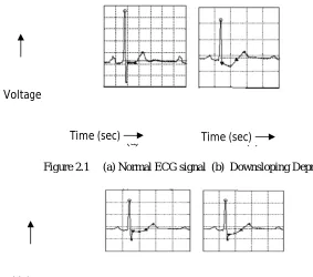 Figure 2.1     (a) Normal ECG signal  (b)  Downsloping Depression 