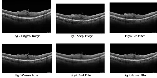 Fig 7 Sigma Filter 