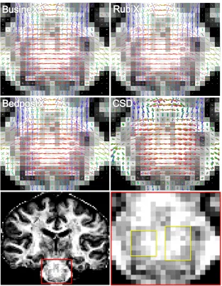 Figure 9: Comparison between BusineX, RubiX, BedpostX and CSD showing improved de-tection of ﬁbers crossing the pons
