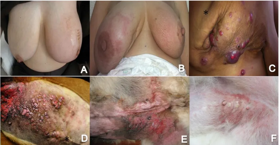 Figure 1 - Fig.1 - Clinical presentation of human IBC with redness, edema, and 