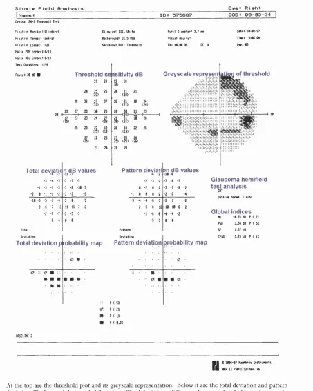 Figure 7 The Statpac printout from the Humphrey Field Analyzer