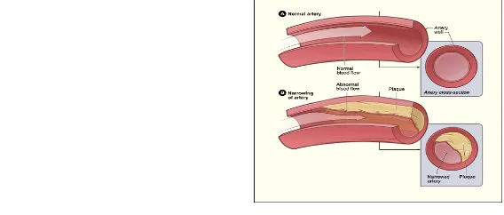 Figure (1): Normal Artery with normal blood flow and Artery with plaques builds ups Coronary heart disease (CHD), also called coronary artery disease, is the #1 killer of both men and women in the United States