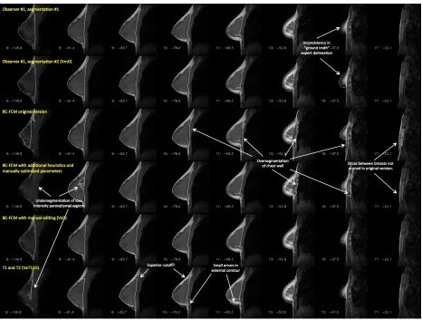 FIG. 6: : Example of a case where automatic segmentation is diﬃcult. The rows representthe results of diﬀerent segmentations and, for compactness, an informative subset of sliceshas been chosen to illustrate important features of the problem
