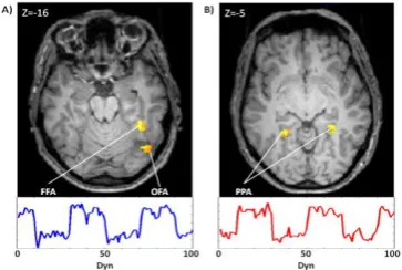 Fig 3(A,B): Example of resulting BOLD activity from GLM     single subject  analysis of BNR-localizer task