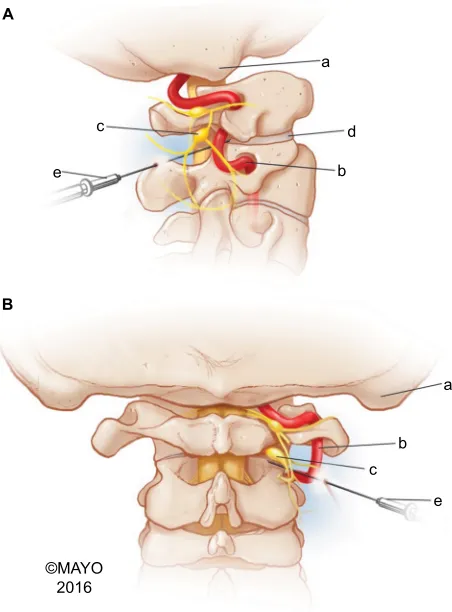 Figure 1 Anatomy of the C1–2 joint.Notes: Lateral (A) and posterior (B) illustration of the approximate needle trajectory for a C1–2 joint injection demonstrating the relationship of the vertebral artery and the C2 nerve root and dorsal root ganglion