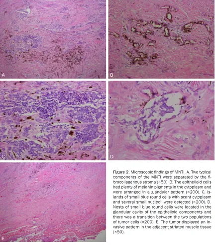 Figure 2. Microscopic findings of MNTI. A. Two typical components of the MNTI were separated by the fi-brocollagenous stroma (×50)