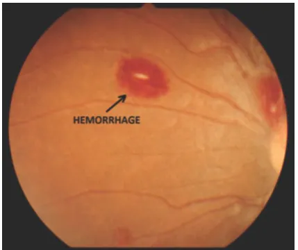Fig. 1  Retinal Hemorrhage 