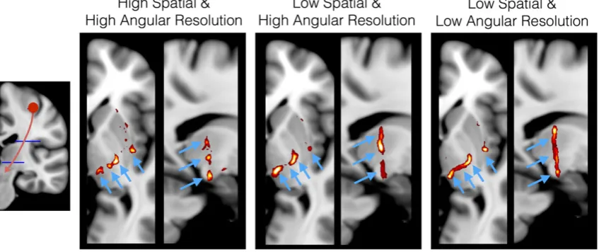 FIGURE 4Tractography results from the hand area of the motor cortex for different spatial and angular resolutions