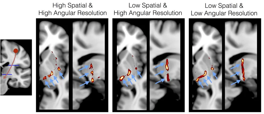 Figure 4. Tractography results from the hand area of the motor cortex for 