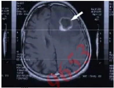 Figure 2[10]. MRI brain tumor image.