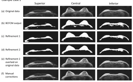 Fig. 4  Small dense breast: rows as for Fig. 3 (RO = 0.88, TPVF = 1.00 and FPVF = 0.13)