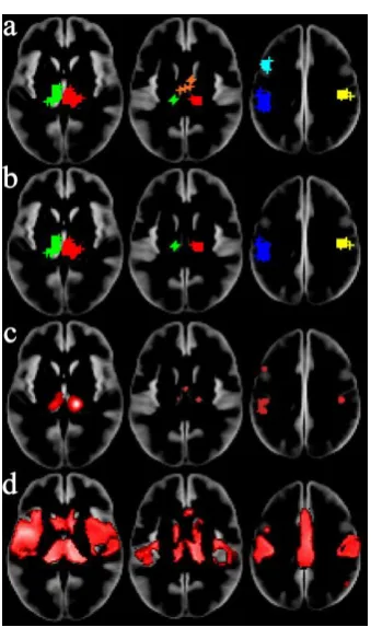 Figure 7. Significant clusters detected in the MS coordinates. a)  is ClusterZ using FCDR  0threshold and cluster extent of 10 voxels