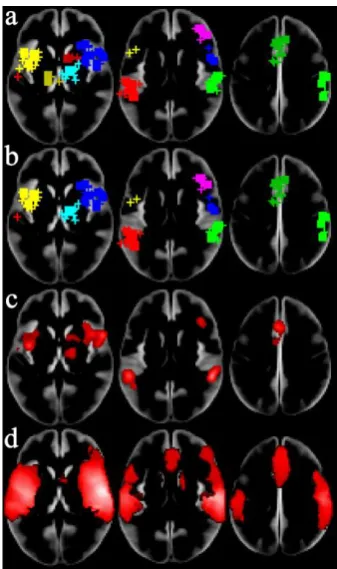 Figure 8. Significant clusters detected in the pain coordinates. a) is ClusterZ using FCDR  005, b) is 