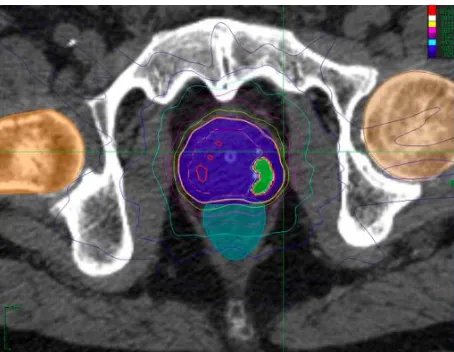 Figure 1. An example of an IPL boost delivered using Cyberknife within the SPARC trial (NCT02145494)