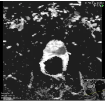 Figure 2- An IMRT delivered IPL boost to a left sided tumour with corresponding MRI and PET-CT imaging