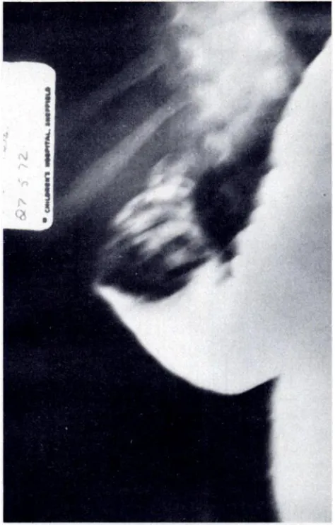 FIG. 1. Bariumenemaoutliningintussusceptionin twin A.