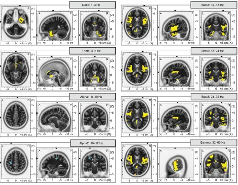 Figure 1 Cortical source activities evoked by cold pressor pain for the eight frequency bands