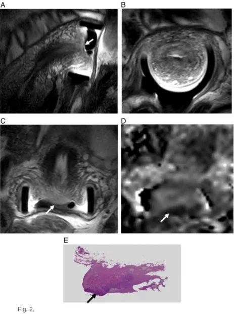 Fig. 2.  Cervical cancer in a 38-year-old female with cone biopsy or LLETZ prior to MRI: sagittal (A), axial (B) and coronal (C) T2-W images using an endovaginal coil show a concave LLETZ defect with an irregular 150 mm3 (17 mm maximum dimension) lesion (arrows) at the transformation zone which, on the 