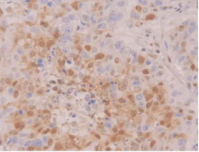 Figure 6. Positive expression of caspase-3 in pros-tatic hyperplasia tissue (×400).