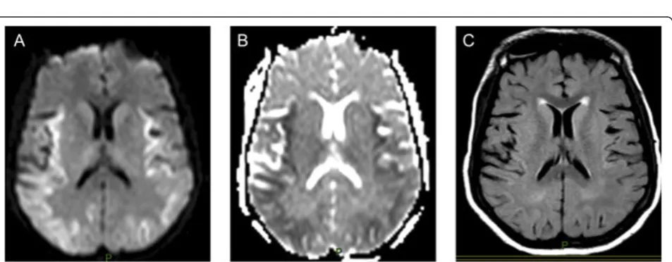 Figure 2 Severe leukoencephalopathy in a septic-shock patient in whom delirium developed