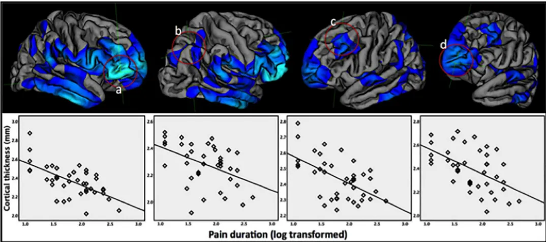 Fig 2. Scatter plots showing negative correlations of cortical thickness with log-transformed pain duration for four regions showing strongest associations(a-d; right pars orbitalis and inferior parietal, and left rostral middle frontal and frontal pole, respectively).