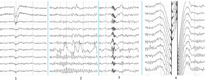 Figure 2.8: The samples of main types of artifacts in human EEG. 1 - Electrooculographic artifact caused by the excitation of eyeball’s muscles