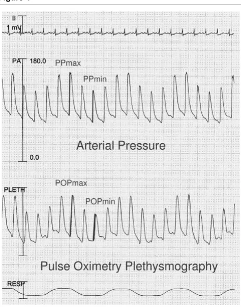 Figure 4play ∆POP values, the POP waveform may be used by the cli-nician by visual inspection alone to assess volume status.
